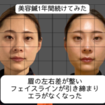 57話美容鍼の効果