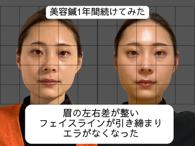 57話美容鍼の効果